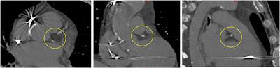 Stereotactic Ablative Radiotherapy of Ventricular Tachycardia Using Tracking: Optimized Target Definition Workflow